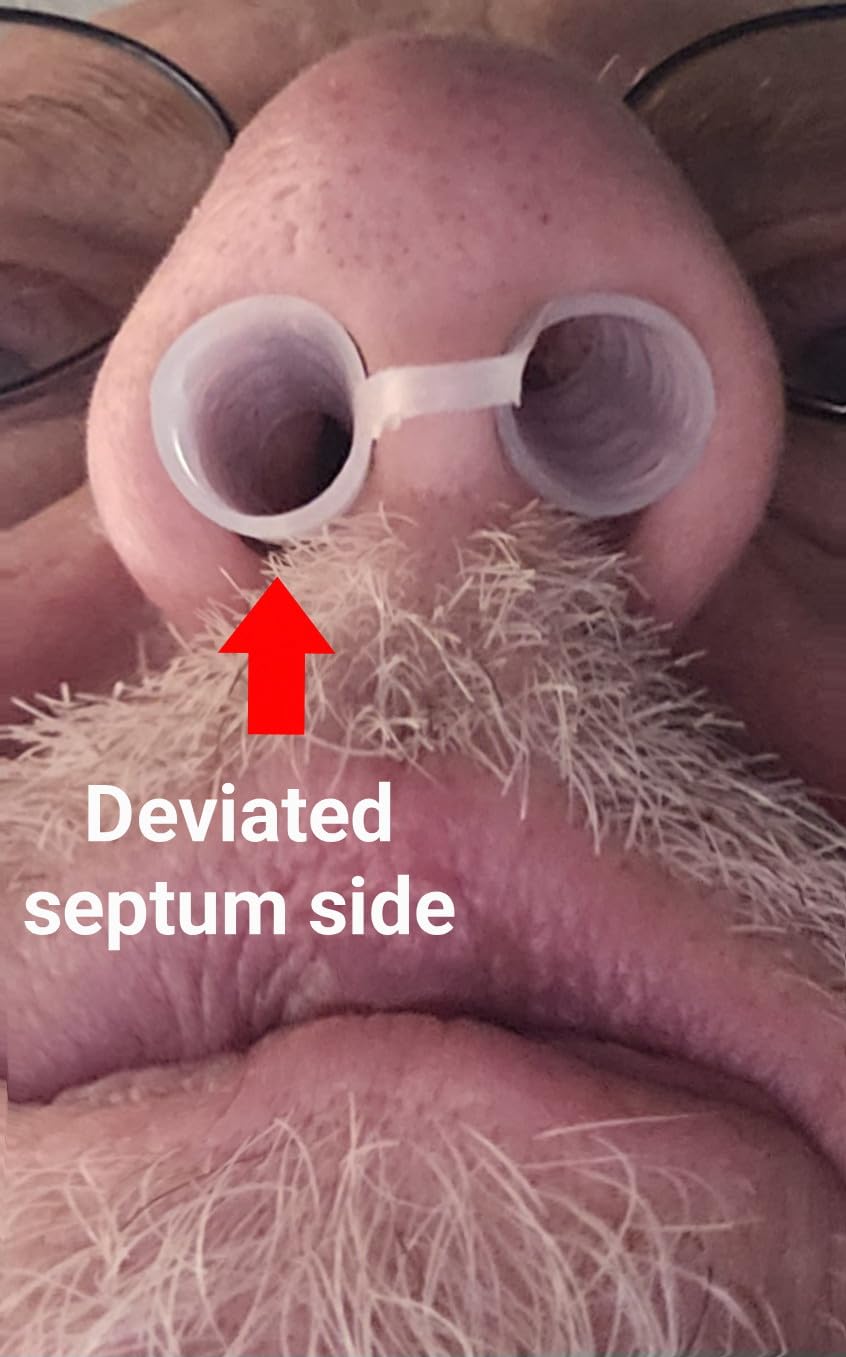 Nasal Dilators for Sleeping - 4 Medium (M) Anti Snoring Nose Vents - Soft Silicone Snore Stopper - Snoring Solution - Nasal Cones to Stop Snoring customer photo 2